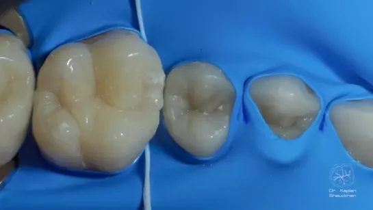 DentalПлюшки 13 - раббердам .Каплан Шеуджен