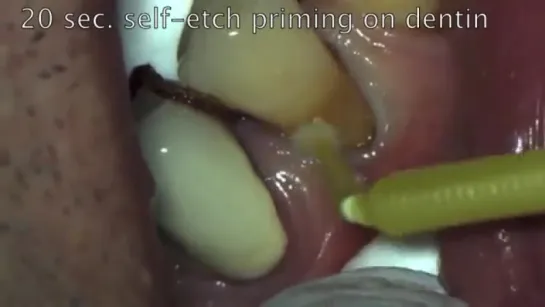 Class V, Cervical composite restoration