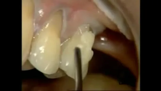 Class V restoration Dr. P. Colon - Dyract eXtra -1