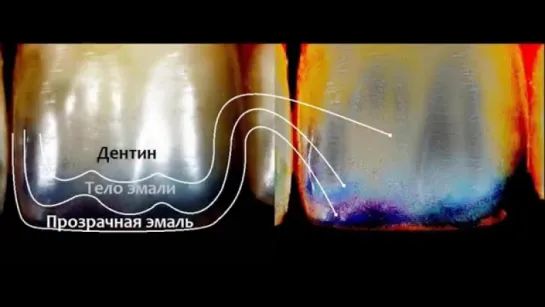 Реставрация Зубов. Планирование и композитная реставрация передних верхних зубов.