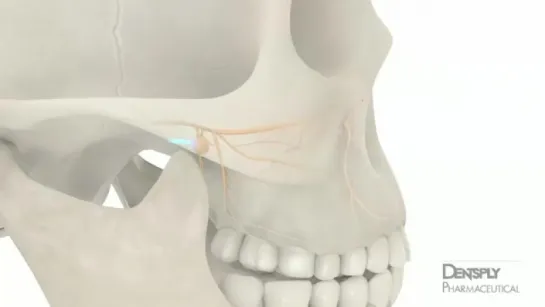 Maxillary Anesthesia Injection Techniques - DENTSPLY Pharmaceutical