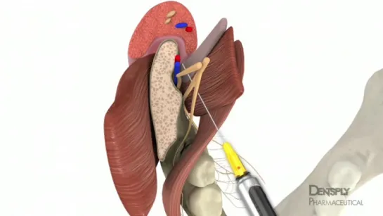 Mandibular Anesthesia Injection Techniques - DENTSPLY Pharmaceutical