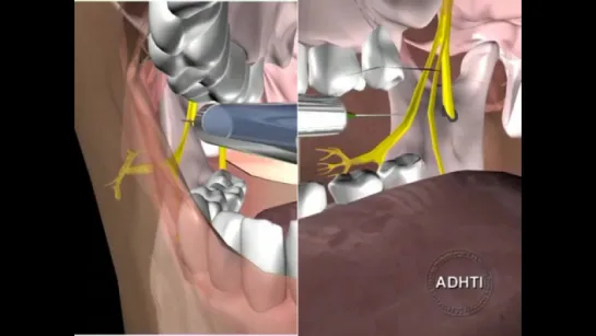 инфильтрационная анестезия верхней челюсти...infiltration anesthesia of the upper jaw