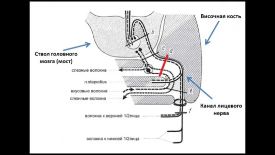 Симптоматика поражения лицевого нерва в канале височной кости. Нейростоматология.