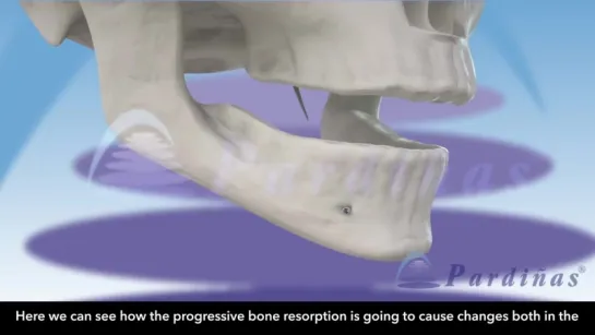 Влияние прогрессирующей резорбции кости на внешний облик и протезирование. Пропедевтика стоматологии.