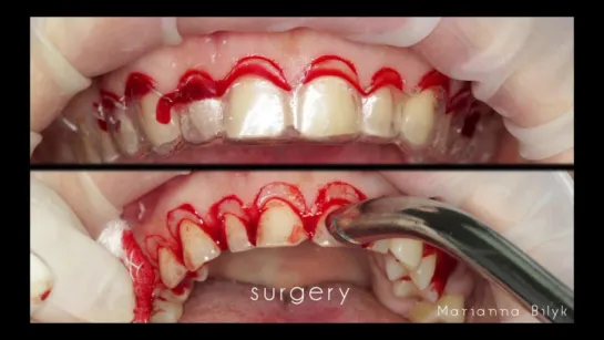 Smile Design - Crown Lengthening - Ceramic Veneers