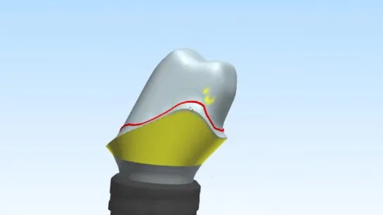 Custom Abutment DesignDesign of a Straumann titanium custom implant abutment for a KDZ Bruxer® crown.