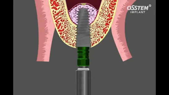 Популярные импланты Osstem.