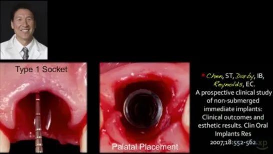 Dental XP эпизоды. Имплантация.