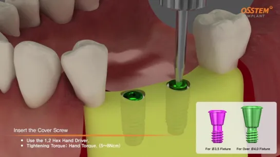 OSSTEM implant - Ортопедический протокол.Имплантация.