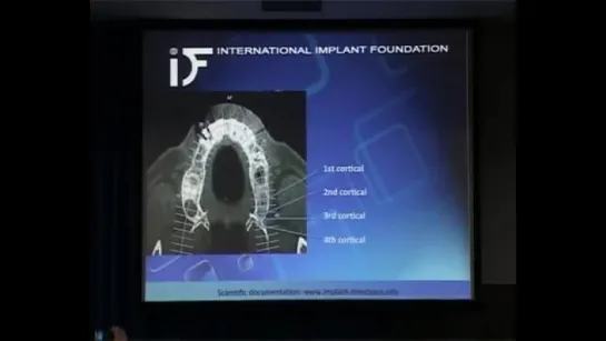 Кортикальная остеоинтеграция ч. 4. Имплантация.