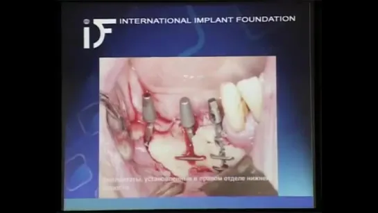 Кортикальная остеоинтеграция ч. 3. Имплантация.