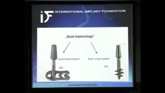 Кортикальная остеоинтеграция ч. 2.Имплантация.