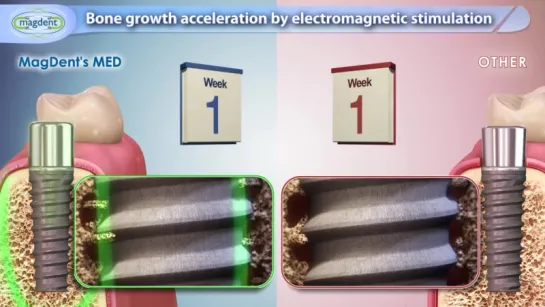 Bone Growth Acceleration by Electromagnetic Stimulation. Имплантация.