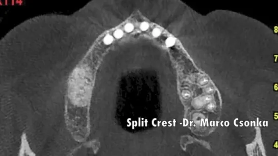 Split Crest using the Magnetic Mallett  Dr. Marco Csonka.  Имплантация.