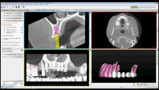 Интеграция в Simplant. Имплантация.