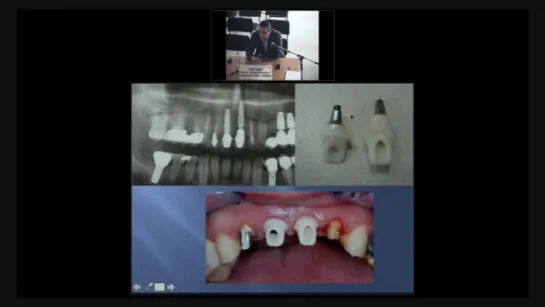 Дентальная имплантация :вчера, сегодня, завтра. Вебинар.
