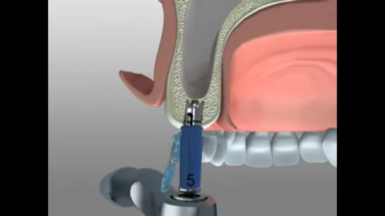 Smart Lift - Kit for Maxillary Sinus Lift with Crestal Approach. Имплантация.