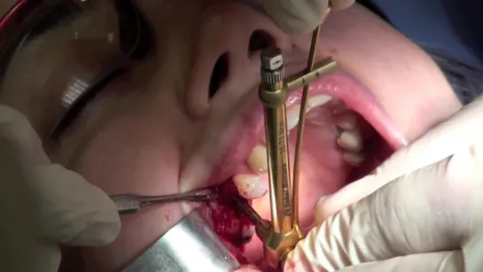 EXPLICIT - Internal Sinus lift - Osteotome technique - Dental Surgery. Имплантация.