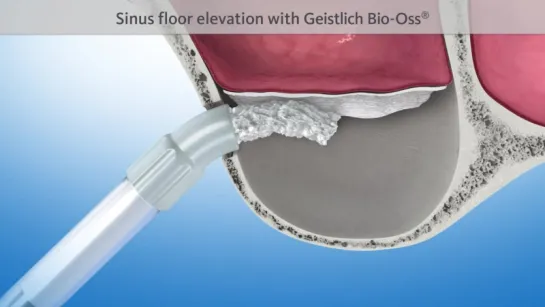 Dental animation- Sinus floor elevation (GEISTLICH). Имплантация.