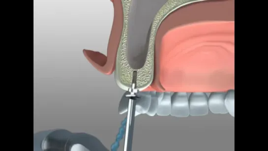 Smart Lift - Kit for Maxillary Sinus Lift with Crestal Approach