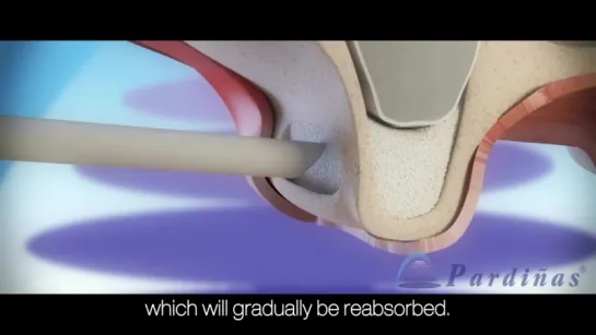 Sinus Lift © Имплантация.