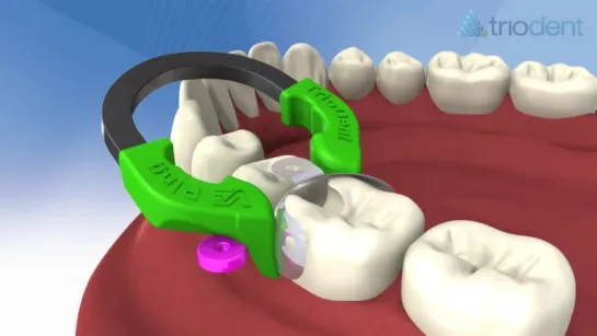 Class II composite restoration using V3 Sectional Matrix System - Triodent