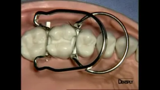 Dentsply - Palodent Demonstration on a dental model.  МАТРИЧНАЯ СИСТЕМА PALODENT Dentsply. Стоматология.