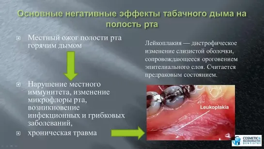 Курение и стоматологические импланты. Ольга Харевич.