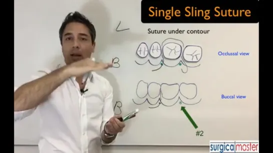 How to perform a sling suture