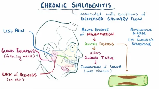 Sialadenitis (sialoadenitis) - causes, symptoms, diagnosis, treatment, pathology. Сиалоаденит. Стоматология.