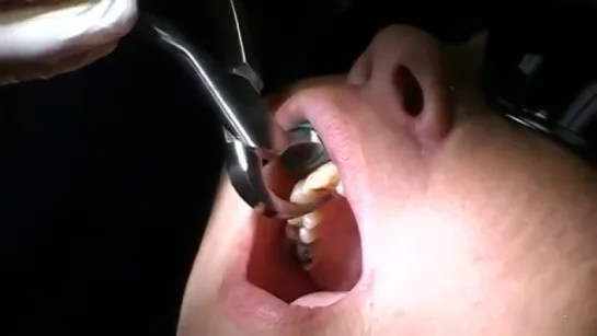 Physics Forceps - Tooth Extraction Upper Anterior #7,8  9. Стоматология.