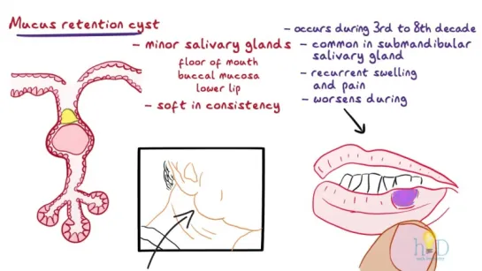 Mucocele - Types, Clinical Features, Histopathology  Treatment.  Стоматология.