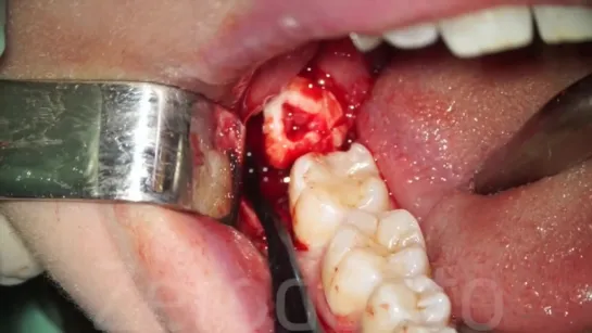 Horizontal semi-impacted wisdom tooth (sonic vs piezosurgery) - Dr. Fabio Cozzol. Сложное удаление зуба мудрости.