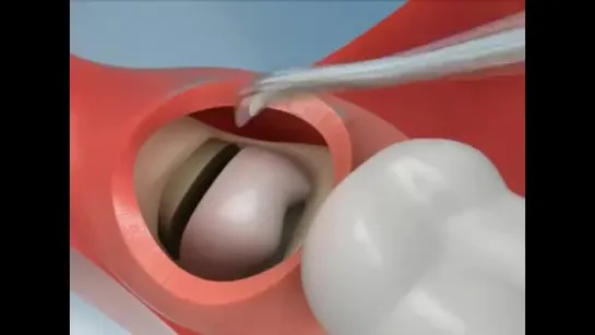 Wisdom Teeth Extraction