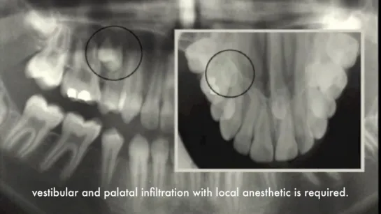 wisdom teeth removal - surgery,extraction - 15,24