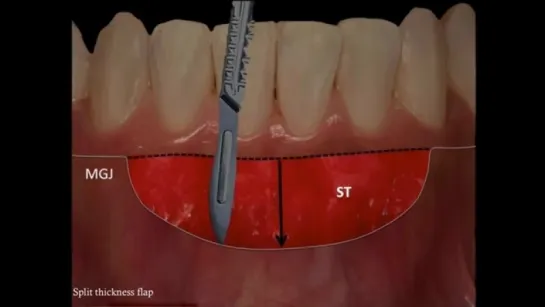 How does a FREE GINGIVAL GRAFT WORK (SurgicalMaster video)