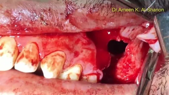 Oro antral Fistula. Пластика ороантрального соустья.