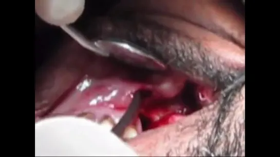 oroantral fistula closure with buccal advancement flap. Пластика ороантрального соустья.