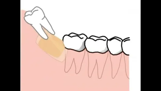 Зуб мудрости в анимационном фильме