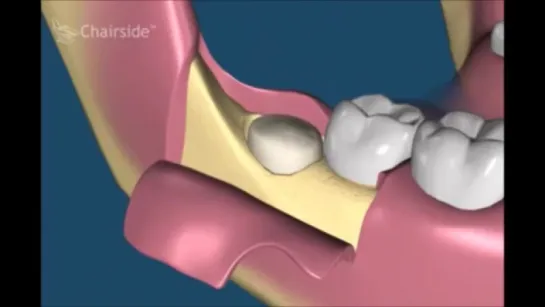 Хирургическая стоматология  Как удалять зубы  Примеры удаления зубов  Сложное удаление