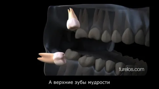 Эстер. Удаление зубов мудрости.Стоматология.