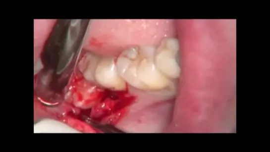 48 tooth extraction with microscop  (удаление зуба мудрости) Стоматология.