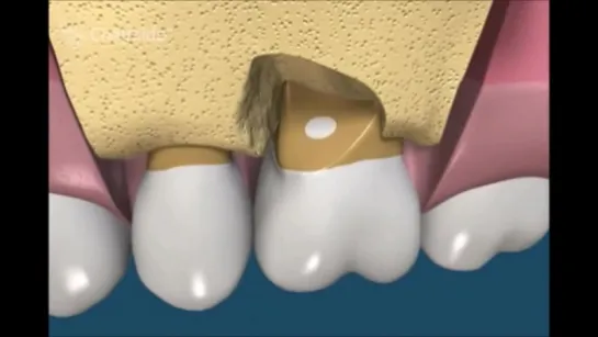 Как сохранить зуб с отломом корня в моляре  Хирургическая стоматология  Гемисекция