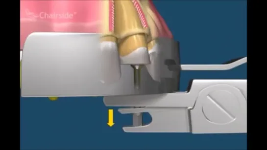 Хирургическая стоматология  Как удалять зубы  Примеры удаления зубов  Сложное удаление