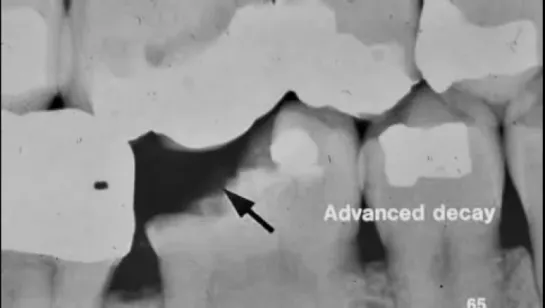 Dental Radiograph Pathology & Restorations -- Part I