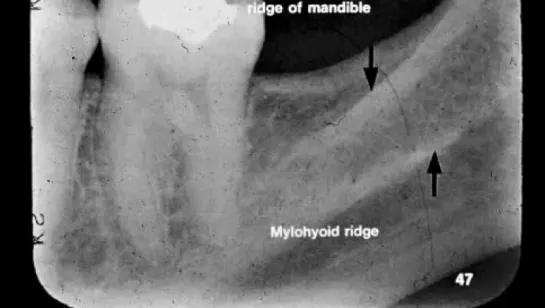 Dental Radiographic Anatomy