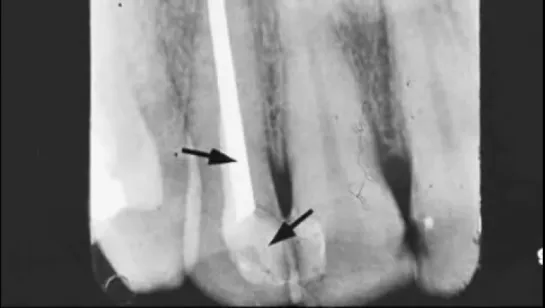 Dental Radiograph Pathology  Restorations -- Part 2