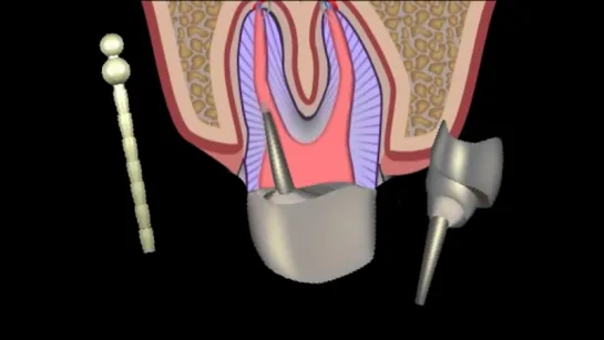 Оттиск корневого канала зуба