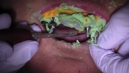 Open Tray Impression - Stabilize Multiple Implants During Final Impression